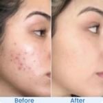anti acne