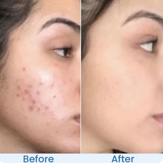 anti acne