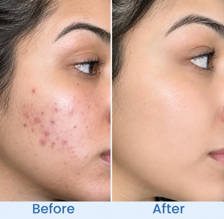 anti-acnefacewash.